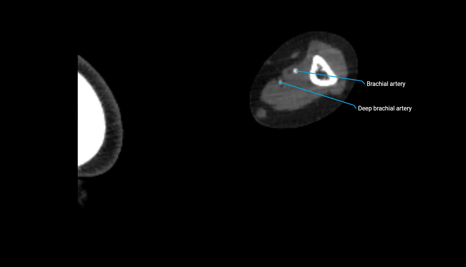 CTA upper limb axial cross sectional anatomy labelled image 210 (2).webp